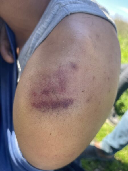 Bruise from Romanian police