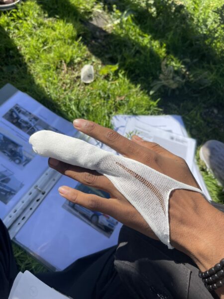 Fractured finger by Romanian police