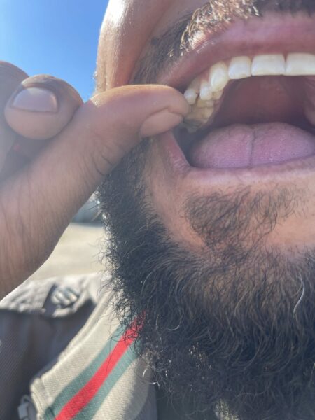 Broken tooth from punch by Romanian officer