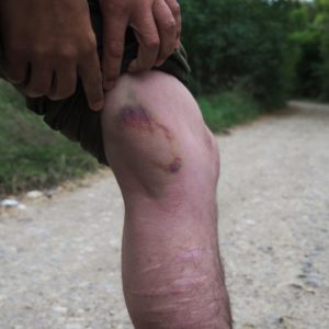 One respondent's injuries after being struck once by a baton. The photo was taken one week after the injuries were sustained.